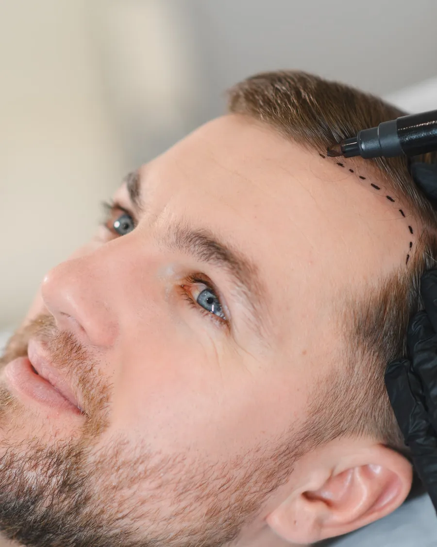 Der Haaransatz einer Patientin wird vor der Haartransplantation bei AS Clinic Berlin angezeichnet