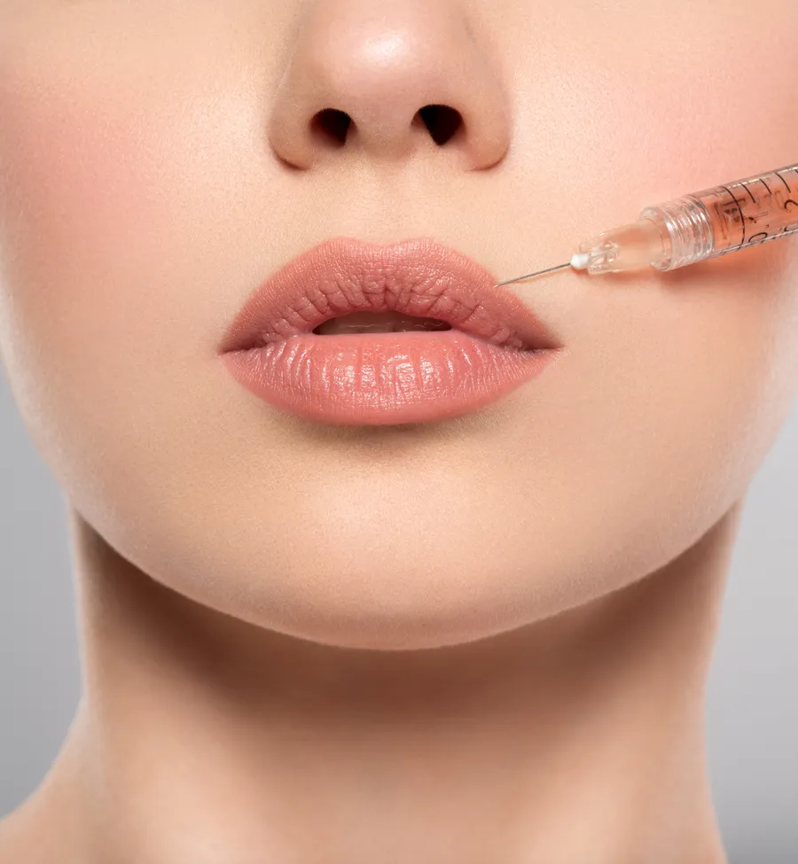 Lippenunterspritzung mit Hyaluronsäure bei AS Clinic Berlin