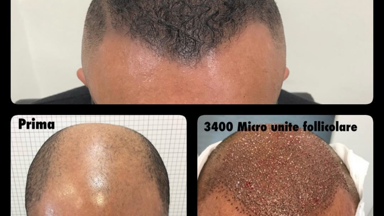 Haartransplantation in Berlin
