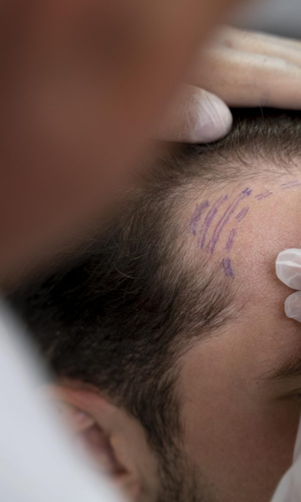 Adult male doing follicular unit extraction 600x1000